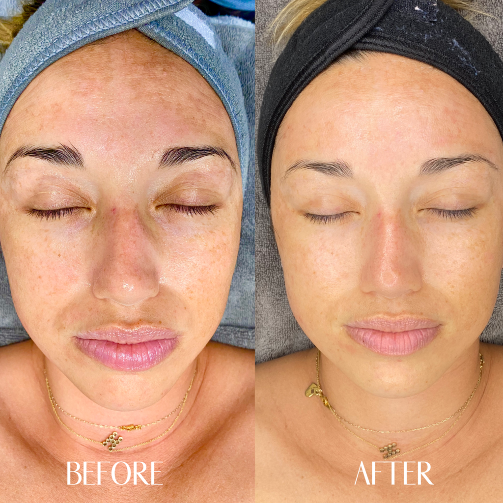 micro needling before and after 6 sessions